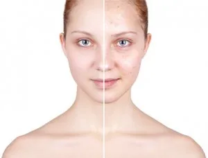 Laser acne scar removal cost in india