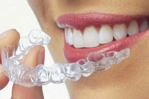 Clear aligners (invisalign, illusion)