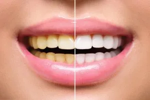 Teeth whitening