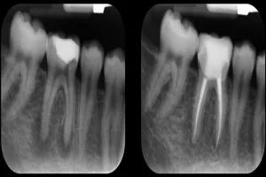 Root canal treatment