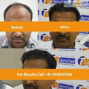 Hair transplant in bangalore, hair clinic in bangalore, la densi