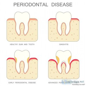 Effective gum disease treatment in singapore