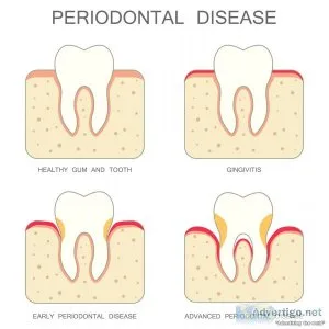 Effective gum disease treatment in singapore