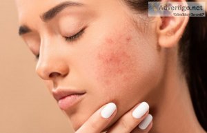 Best acne doctor in gurgaon: dr niti gaur