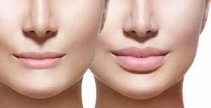 Best dermal fillers in dubai | la vida