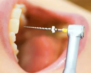 Single sitting root canal treatment in hyderabad