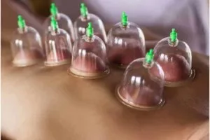 Things to know before having a cupping treatment