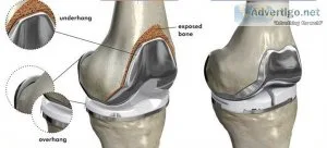 Best knee replacement surgeon in delhi ncr