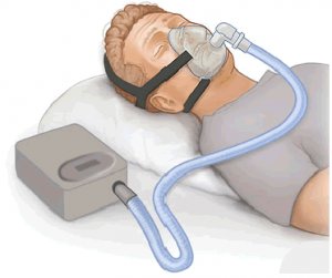 Sleep apnea treatment by dr sheetu singh