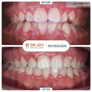 Invisalign in dubai