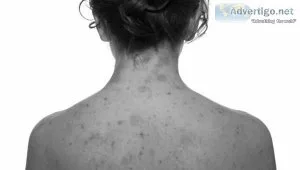Discover relief for your skin allergies and eczema
