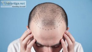 Best hair transplant in indore