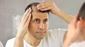Best hair loss treatment in bangalore- Hair loss treatment 