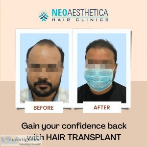 Discover lucknow s top hair transplant surgeon