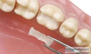 Tooth colored filling