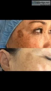 Say Goodbye To Age Spots With Our Laser Treatment