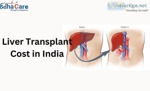 Affordable liver transplant costs in india