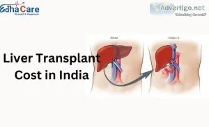 Affordable liver transplant costs in india