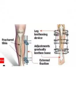 Limb lengthening surgery