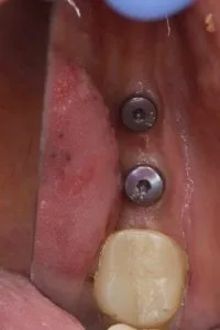 Vanilla smiles: your ultimate destination for dental implants in
