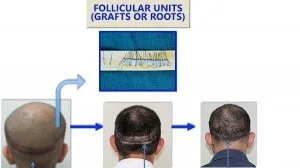Fut hair transplant in india