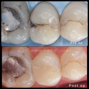 Excellence in tooth-coloured fillings: vanilla smiles dental cli
