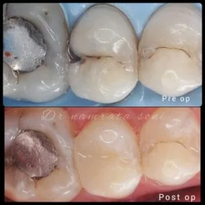 Excellence in tooth-coloured fillings: vanilla smiles dental cli