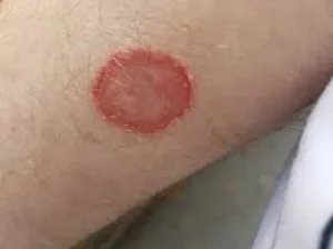Rapid relief: how to cure ringworm fast