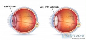 Cataract surgery in bangalore