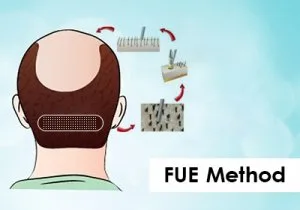 Affordability of fue hair transplants in india