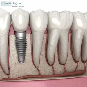 Best dental implants in pune | affordable tooth implants in pimp