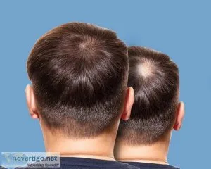 Hair transplant treatment in chennai