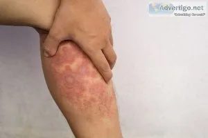 Embrace relief: ayurvedic treatment for eczema