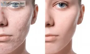 Acne scar removal