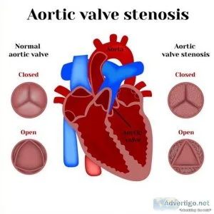 Transcatheter aortic valve replacement specialist