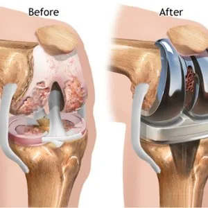 Best knee replacement surgery doctor in noida