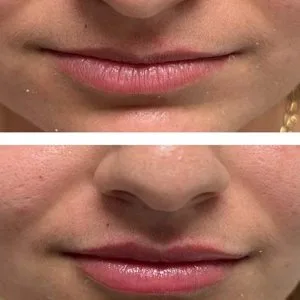 Get the best lip fillers in riverside, ca