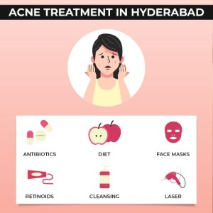 Acne treatment in hyderabad