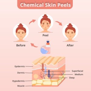 Chemical peel treatment in hyderabad