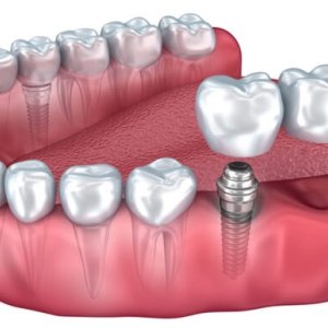 Genuine cost of dental implants in gurgaon