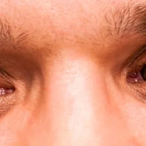 The best squint eyes treatment in delhi, india