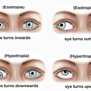 Best squint in eyes treatment available in delhi