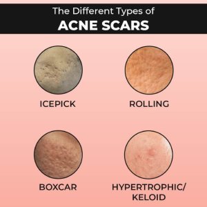 Acne scar treatment cost in hyderabad