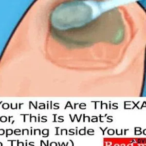How To Clear Nail Fungus 3X Faster Even While Sleeping