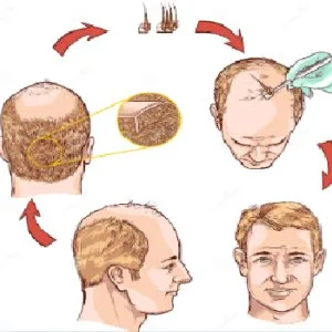 Hair transplantation in prayagraj , uttar pradesh