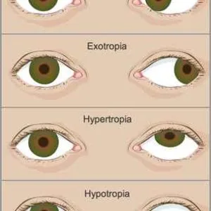 Top hospital for squint in eyes treatment in delhi