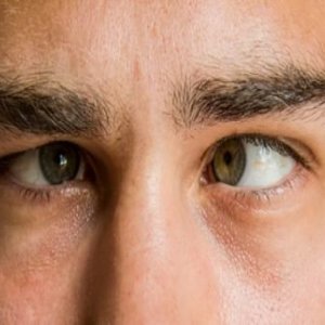 Best squint in eyes treatment in delhi