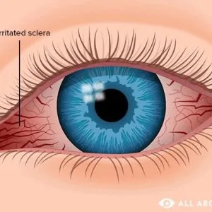 Best eye hospital for red eye treatment in delhi