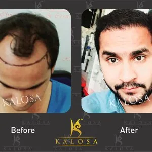 Elevate your beauty: female hair transplant