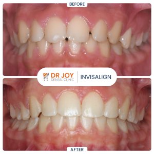 Invisalign in dubai